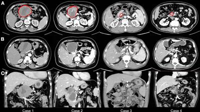 Selective use of pancreatic duct occlusion during pancreaticoduodenectomy in patients with a small-size duct and atrophic parenchyma in the distal pancreas: A retrospective study